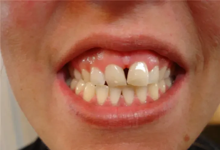 before smile view of misaligned front teeth with gap between central incisors
