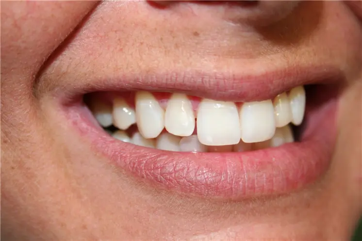before smile view of uneven upper front teeth with small gap
